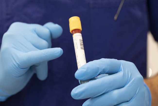 Prostate-specific antigen (PSA) blood test